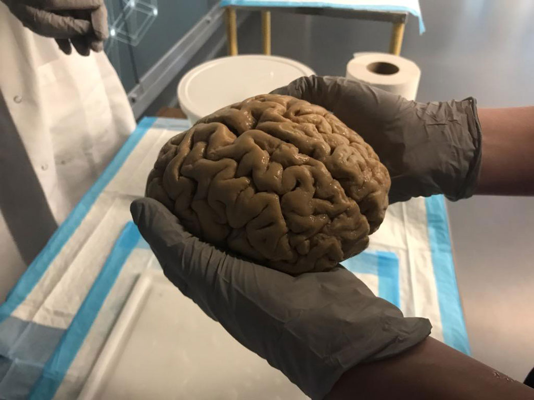 Huntington's Tess Stanley holds a human brain in her hands during a summer program at McGill University in Canada.